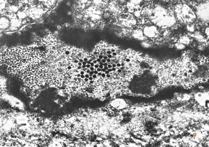 F,43y. | herpetic tracheobronchitis F,43y. | herpetic tracheobronchitis
